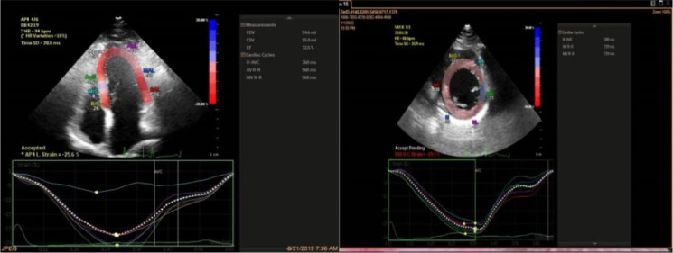 Dyspnea in pregnancy might be related to the incomplete physiological adaptation of the heart.