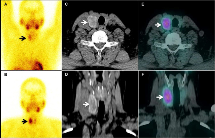 Toxic thyroid adenoma with hypercalcemia mimicking an intra-thyroidal parathyroid adenoma.