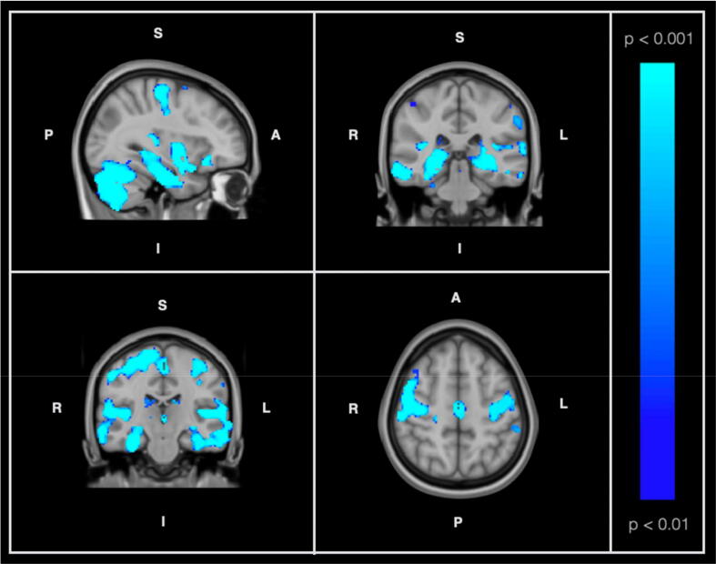 The relationship between cardiovascular risk and lifestyle activities on hippocampal volumes in normative aging