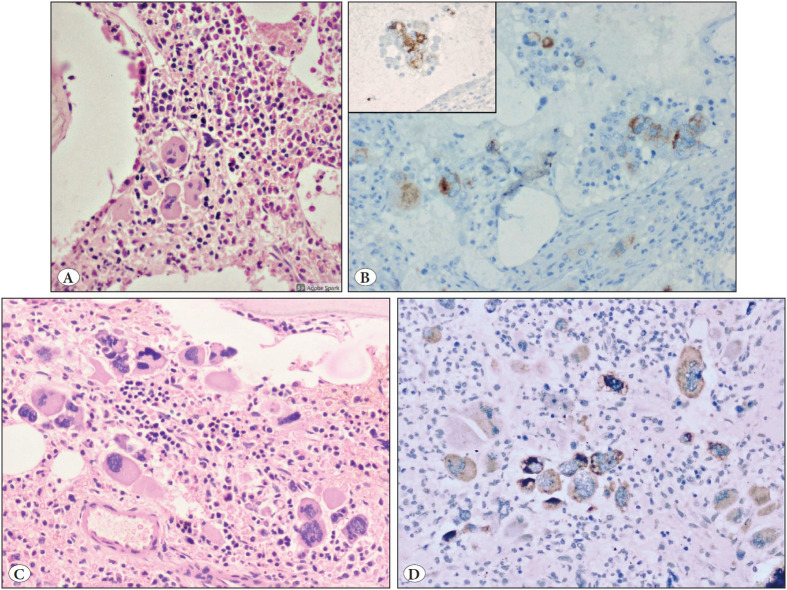 Calreticulin Immunohistochemistry in Myeloproliferative Neoplasms - Evolution of a New Cost-Effective Diagnostic Tool: A Retrospective Study with Histological and Molecular Correlation.