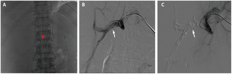 Case Report: Massive Hepatocellular Carcinoma Complete Surgical Resection After Portal Vein Embolization and Multimodality Therapy.