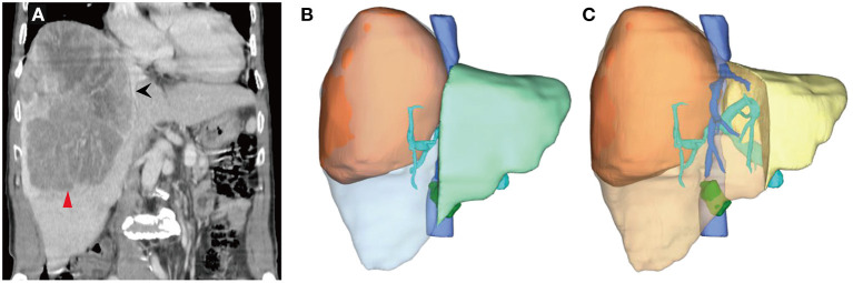 Case Report: Massive Hepatocellular Carcinoma Complete Surgical Resection After Portal Vein Embolization and Multimodality Therapy.