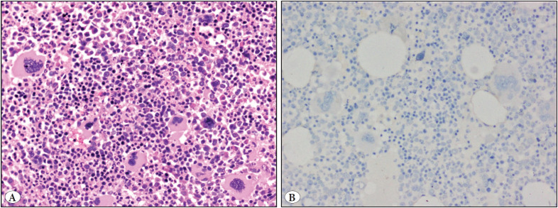 Calreticulin Immunohistochemistry in Myeloproliferative Neoplasms - Evolution of a New Cost-Effective Diagnostic Tool: A Retrospective Study with Histological and Molecular Correlation.