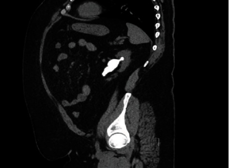 Percutaneous Nephrolithotripsy in Morbidly Obese Patient: A Case Report.