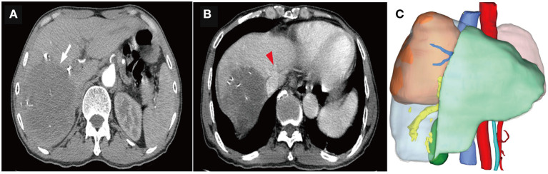 Case Report: Massive Hepatocellular Carcinoma Complete Surgical Resection After Portal Vein Embolization and Multimodality Therapy.