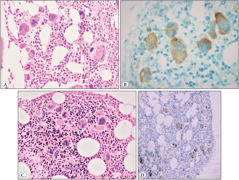 Calreticulin Immunohistochemistry in Myeloproliferative Neoplasms - Evolution of a New Cost-Effective Diagnostic Tool: A Retrospective Study with Histological and Molecular Correlation.