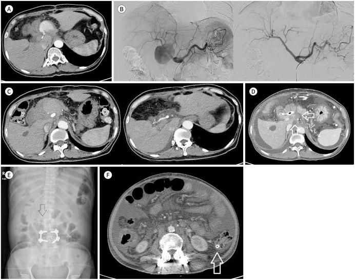 Jejunal Migration of the Stent-Graft Used for Common Hepatic Artery Pseudoaneurysm.