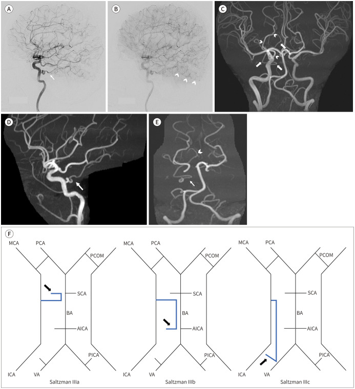Persistent Trigeminal Artery Variant Terminating in the Ipsilateral Superior Cerebellar Artery.