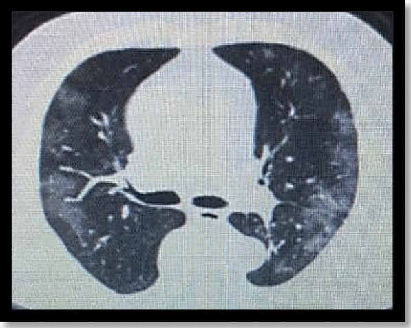 Lysosomal storage diseases in the era of COVID-19: a report of an Egyptian case of alpha-fucosidosis and a summary of the lysosomal storage diseases-COVID-19 relationship.