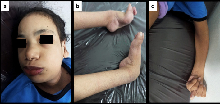 Lysosomal storage diseases in the era of COVID-19: a report of an Egyptian case of alpha-fucosidosis and a summary of the lysosomal storage diseases-COVID-19 relationship.