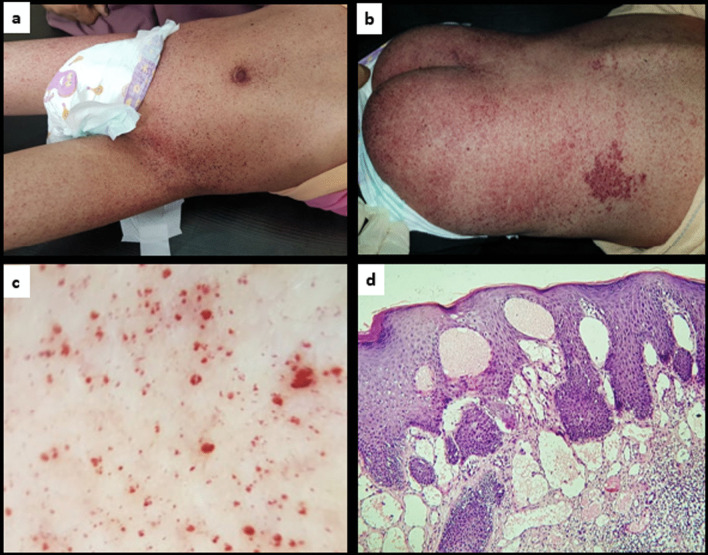 Lysosomal storage diseases in the era of COVID-19: a report of an Egyptian case of alpha-fucosidosis and a summary of the lysosomal storage diseases-COVID-19 relationship.