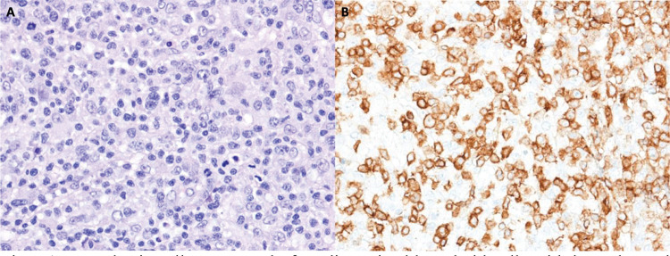 Peripheral T-Cell Lymphoma, Not Otherwise Specified - a case report and short literature review.