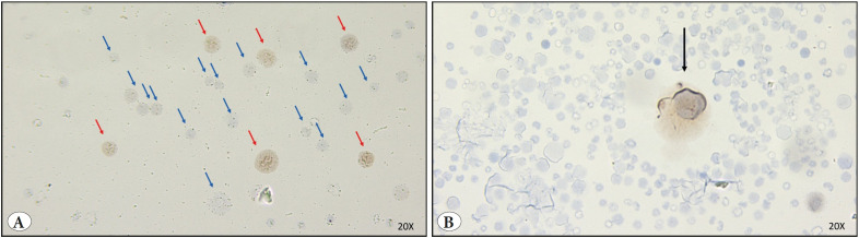 Analysis of DUX4 Expression in Bone Marrow and Re-Discussion of DUX4 Function in the Health and Disease.