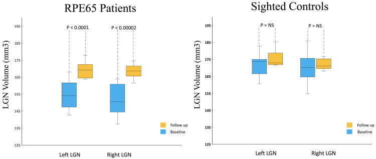 Neuroplasticity of the Lateral Geniculate Nucleus in Response to Retinal Gene Therapy in a Group of Patients with <i>RPE65</i> Mutations.