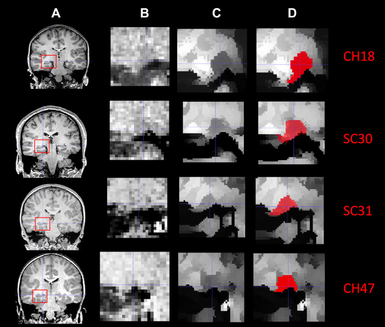 Neuroplasticity of the Lateral Geniculate Nucleus in Response to Retinal Gene Therapy in a Group of Patients with <i>RPE65</i> Mutations.