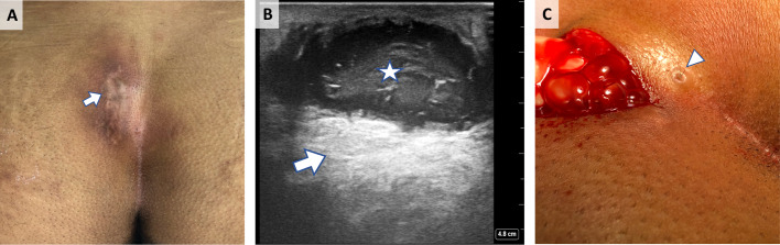 The Role of Point-of-Care Ultrasound in Pilonidal Sinus Disease.