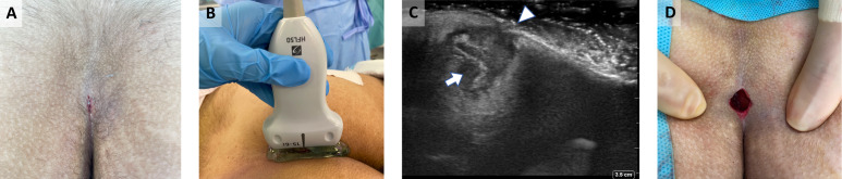 The Role of Point-of-Care Ultrasound in Pilonidal Sinus Disease.