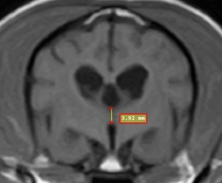 MRI abnormalities in a severe cognitive impairment mimicking a forebrain lesion in a geriatric dog.