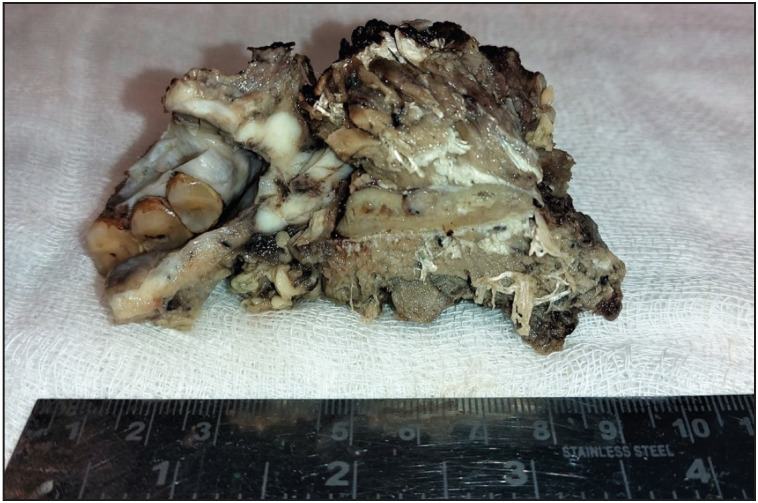 Evaluation of Histomorphological Parameters to Predict Occult Nodal Metastasis in Early-Stage Oral Squamous Cell Carcinoma.