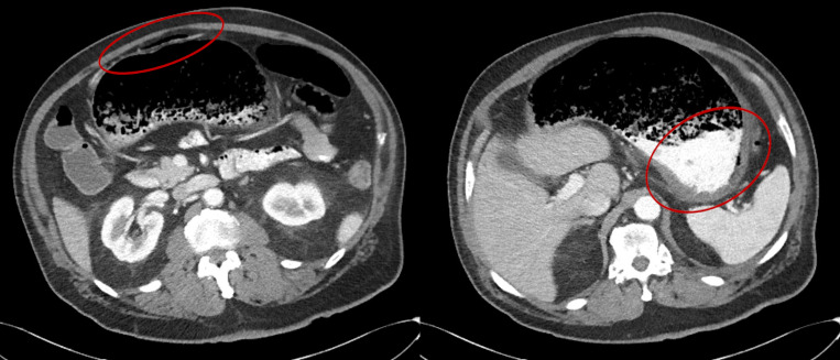 POCUS Finding of Portal Venous Gas: An Unusual Consequence of an Amyloid Dysmotility Related Bezoar.