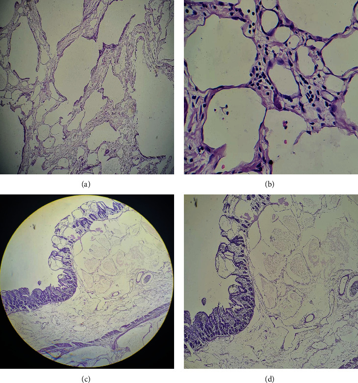 A Huge Mesenteric Lymphangioma Presenting as a Small Bowel Volvulus in a Paediatric Patient: A Case Report.