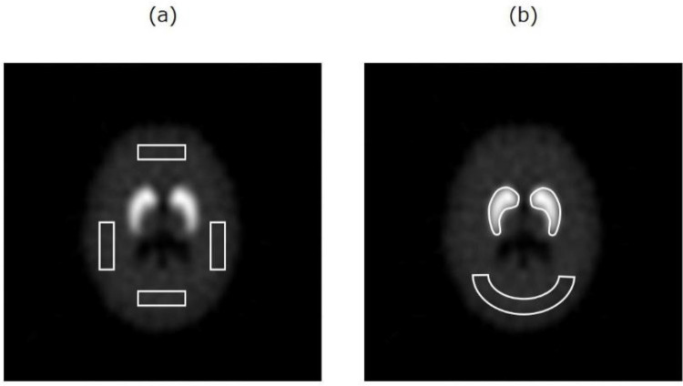 Combination of compressed sensing-based iterative reconstruction and offset acquisition for I-123 FP-CIT SPECT: a simulation study.