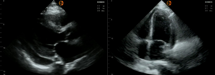 POCUS Finding of Portal Venous Gas: An Unusual Consequence of an Amyloid Dysmotility Related Bezoar.