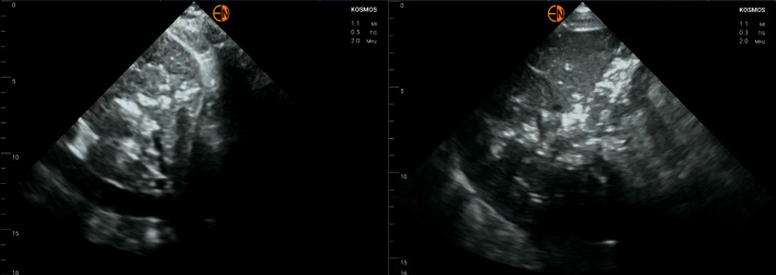 POCUS Finding of Portal Venous Gas: An Unusual Consequence of an Amyloid Dysmotility Related Bezoar.