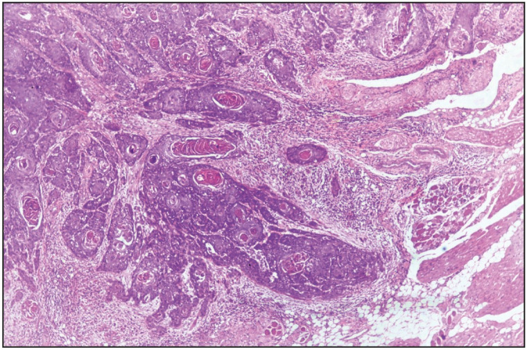 Evaluation of Histomorphological Parameters to Predict Occult Nodal Metastasis in Early-Stage Oral Squamous Cell Carcinoma.