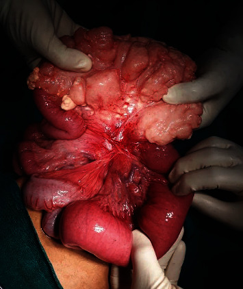 A Huge Mesenteric Lymphangioma Presenting as a Small Bowel Volvulus in a Paediatric Patient: A Case Report.