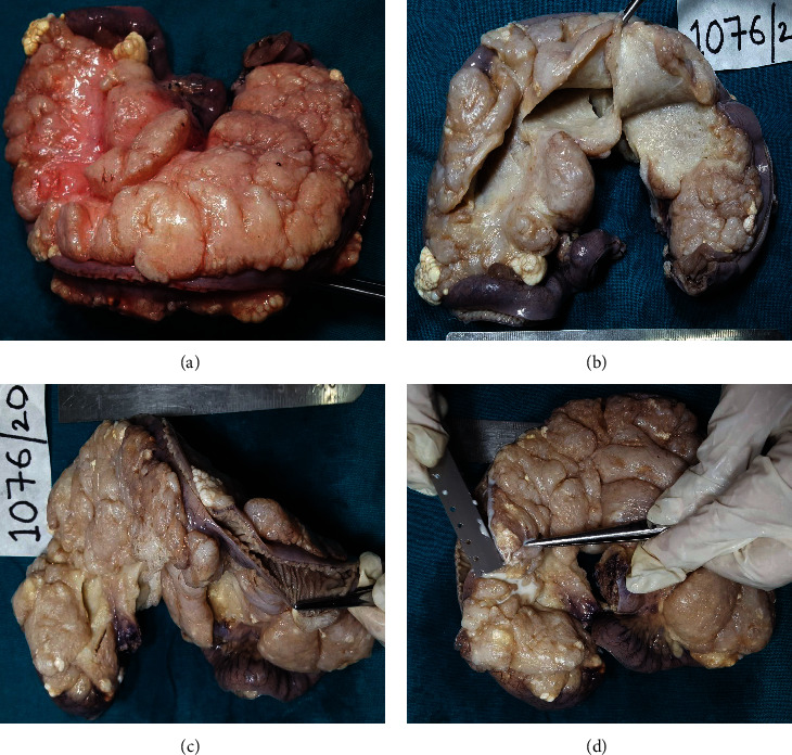 A Huge Mesenteric Lymphangioma Presenting as a Small Bowel Volvulus in a Paediatric Patient: A Case Report.