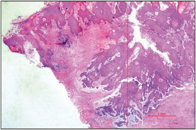 Evaluation of Histomorphological Parameters to Predict Occult Nodal Metastasis in Early-Stage Oral Squamous Cell Carcinoma.