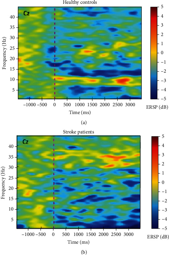 The Neurophysiological Impact of Subacute Stroke: Changes in Cortical Oscillations Evoked by Bimanual Finger Movement.