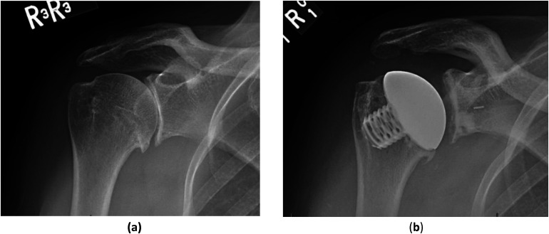 Glenoid Prosthesis Design Considerations in Anatomic Total Shoulder Arthroplasty.