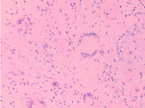 Co-existence of metastatic uterine sarcoma and orbital sarcoidosis: A case report and literature review.