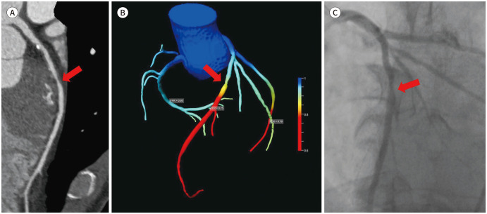 [Beyond Coronary CT Angiography: CT Fractional Flow Reserve and Perfusion].