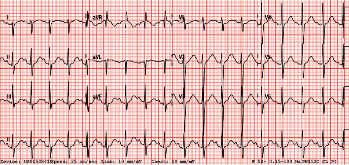 Acute Flaccid Tetraparesis after COVID-19 Infection: Think of the Thyroid.