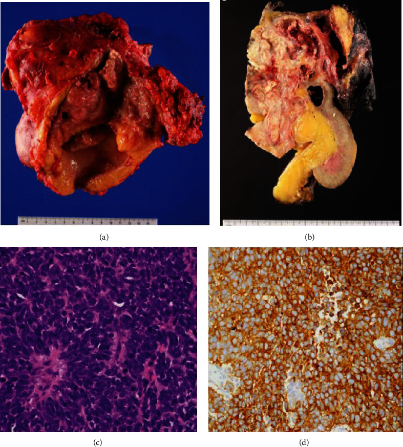 Donor-Derived Urothelial Carcinoma in Renal Transplant Recipients.