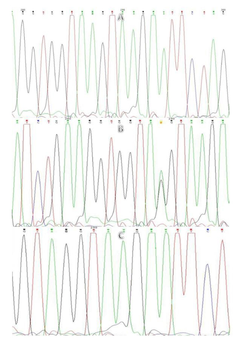 DNA sequencing validation by PCR-RFLP for evaluating butyrophilin-like 2 rs2076530 polymorphism in Iranian patients with sarcoidosis.