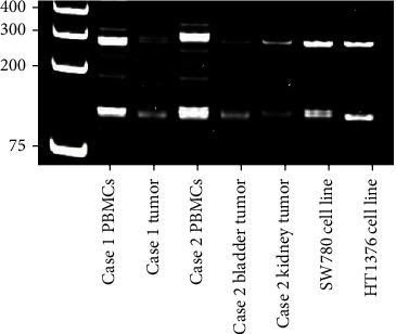 Donor-Derived Urothelial Carcinoma in Renal Transplant Recipients.