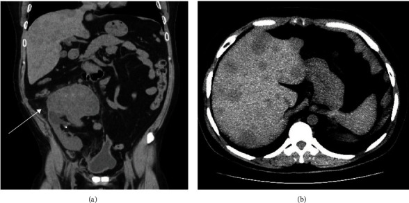 Donor-Derived Urothelial Carcinoma in Renal Transplant Recipients.