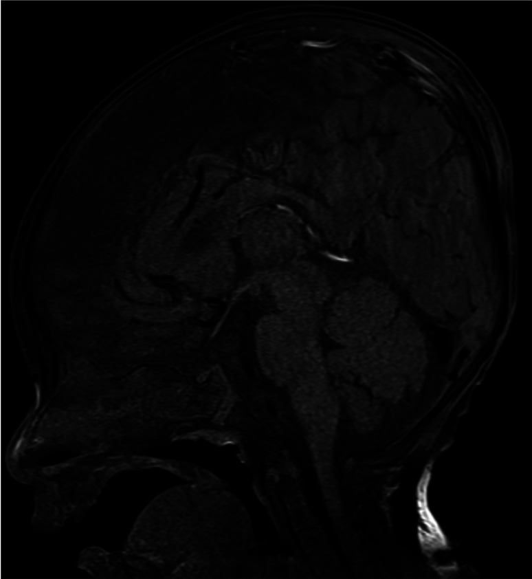 Transient central diabetes insipidus after cranioplasty for craniosynostosis in an infant with septo-optic dysplasia.
