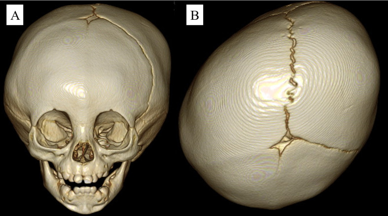 Transient central diabetes insipidus after cranioplasty for craniosynostosis in an infant with septo-optic dysplasia.