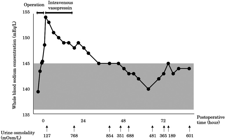 Transient central diabetes insipidus after cranioplasty for craniosynostosis in an infant with septo-optic dysplasia.
