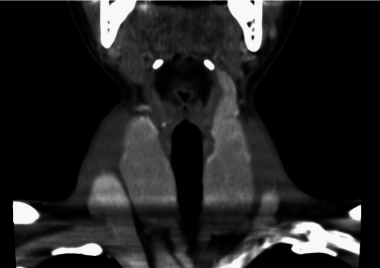 Goiter in a 6-year-old patient with novel thyroglobulin gene variant (Gly145Glu) causing intracellular thyroglobulin transport disorder: Correlation between goiter size and the free T3 to free T4 ratio.