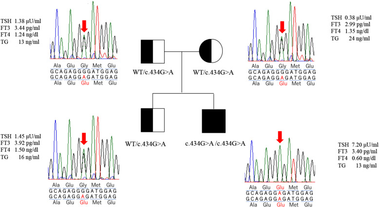Goiter in a 6-year-old patient with novel thyroglobulin gene variant (Gly145Glu) causing intracellular thyroglobulin transport disorder: Correlation between goiter size and the free T3 to free T4 ratio.