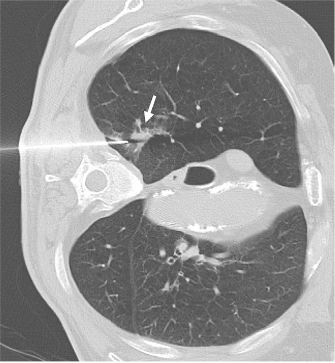 Complications and diagnostic accuracy of CT-guided 18G tru-cut versus end-cut percutaneous core needle biopsy of solitary solid lung nodules.