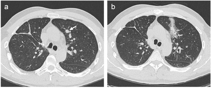 Complications and diagnostic accuracy of CT-guided 18G tru-cut versus end-cut percutaneous core needle biopsy of solitary solid lung nodules.