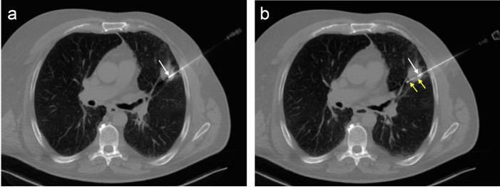 Complications and diagnostic accuracy of CT-guided 18G tru-cut versus end-cut percutaneous core needle biopsy of solitary solid lung nodules.