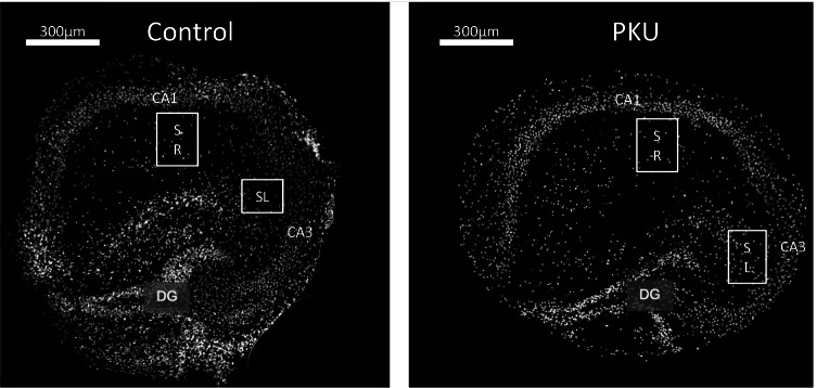 A culture model for the assessment of phenylalanine neurotoxicity in phenylketonuria.
